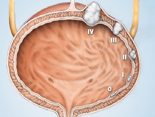 стадии развития рака мочевого пузыря стадии развития рака мочевого пузыря