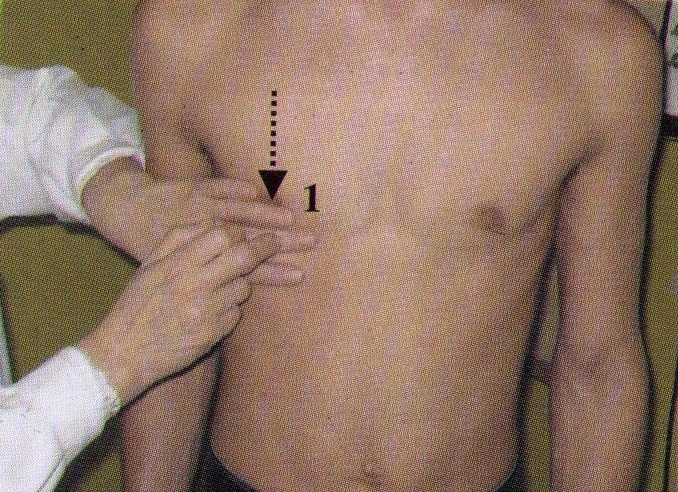 перкуссия печени перкуссия печени