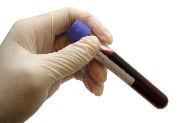 онкомаркер SCC онкомаркер SCC