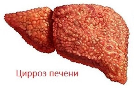 Цирроз печени - возможная причина развития рака Цирроз печени - возможная причина развития рака