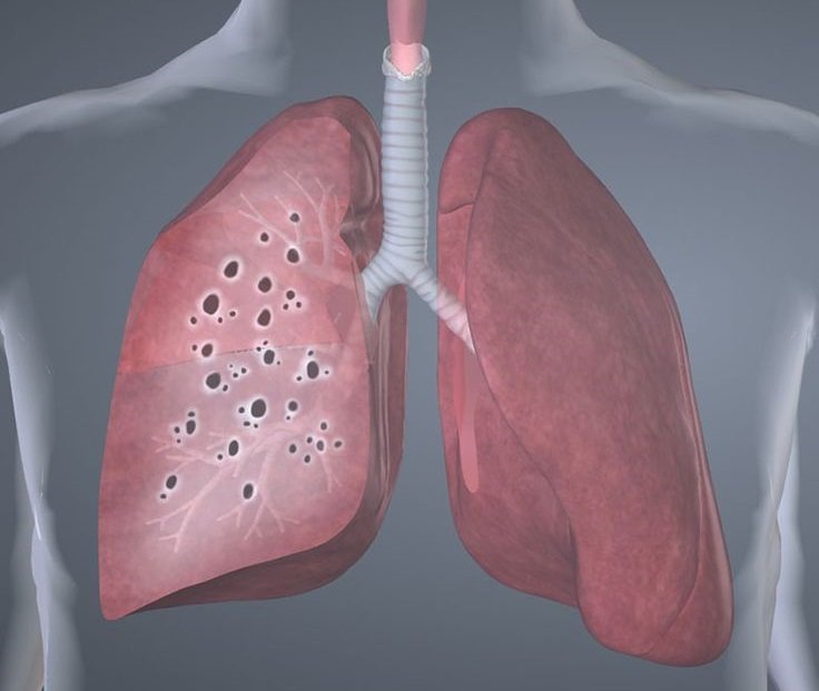 саркоидоз легких саркоидоз легких