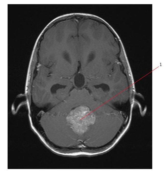 Эпендимома Эпендимома