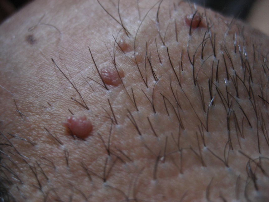 Генитальные папилломы у женщин Генитальные папилломы у женщин