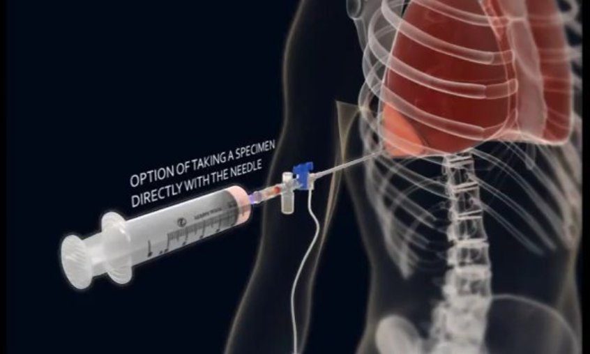 Плевродез Плевродез