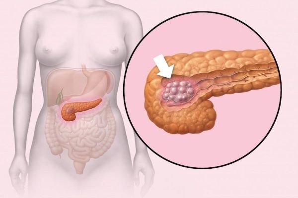Глюкагонома Глюкагонома