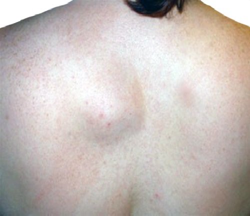 Саркома мягких тканей Саркома мягких тканей