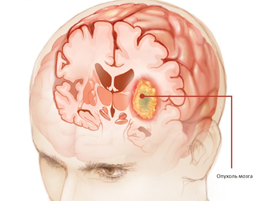 Опухоль головного мозга Опухоль головного мозга