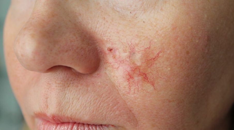 Склеродермоподобная базалиома Склеродермоподобная базалиома