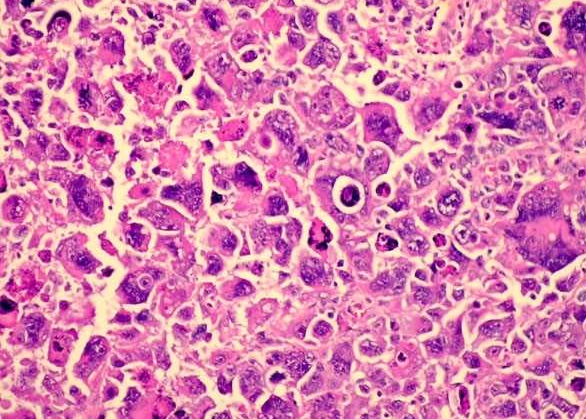 Плеоморфная рабдомиосаркома Плеоморфная рабдомиосаркома