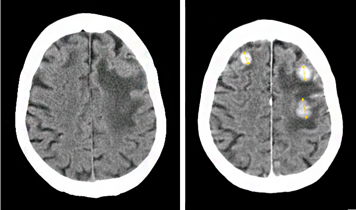 Метастазы в головном мозге Метастазы в головном мозге