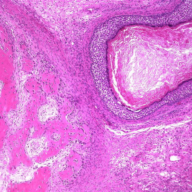 тератома что это такое тератома что это такое