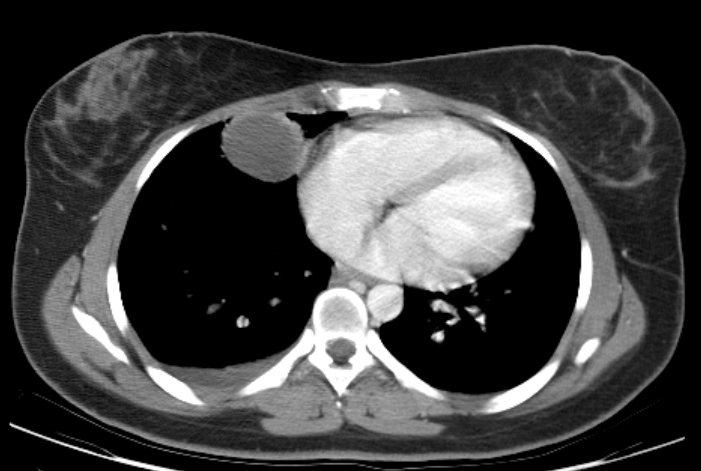 Тератома средостения Тератома средостения