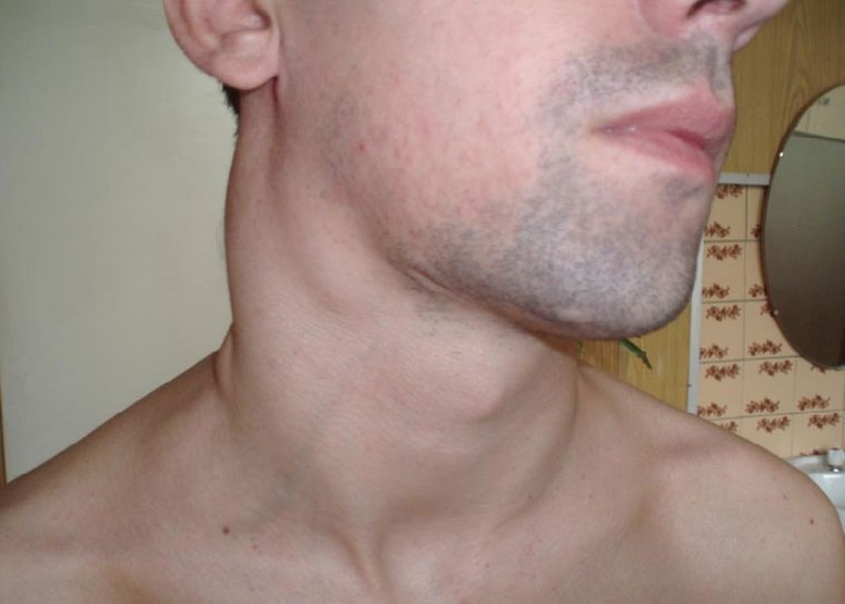 Увеличение лимфоузлов - признак онкологии Увеличение лимфоузлов - признак онкологии