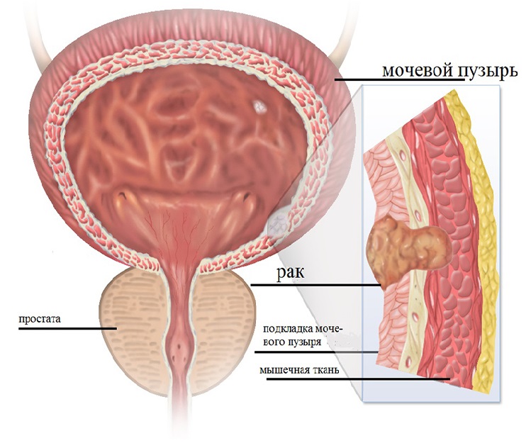 Рак мочевого пузыря Рак мочевого пузыря