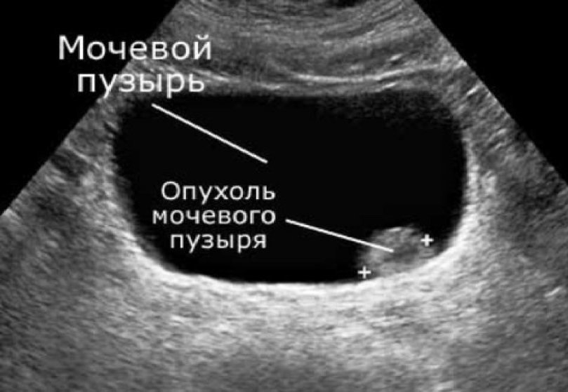 узи мочевого пузыря узи мочевого пузыря
