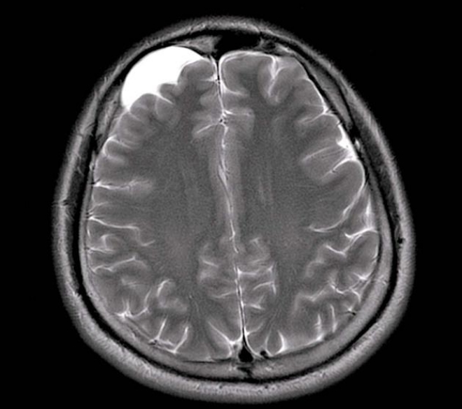 Арахноидальная киста Арахноидальная киста