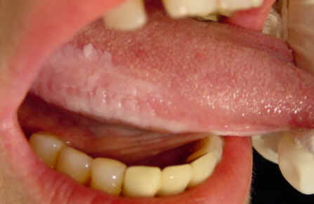 Лейкоплакия Лейкоплакия