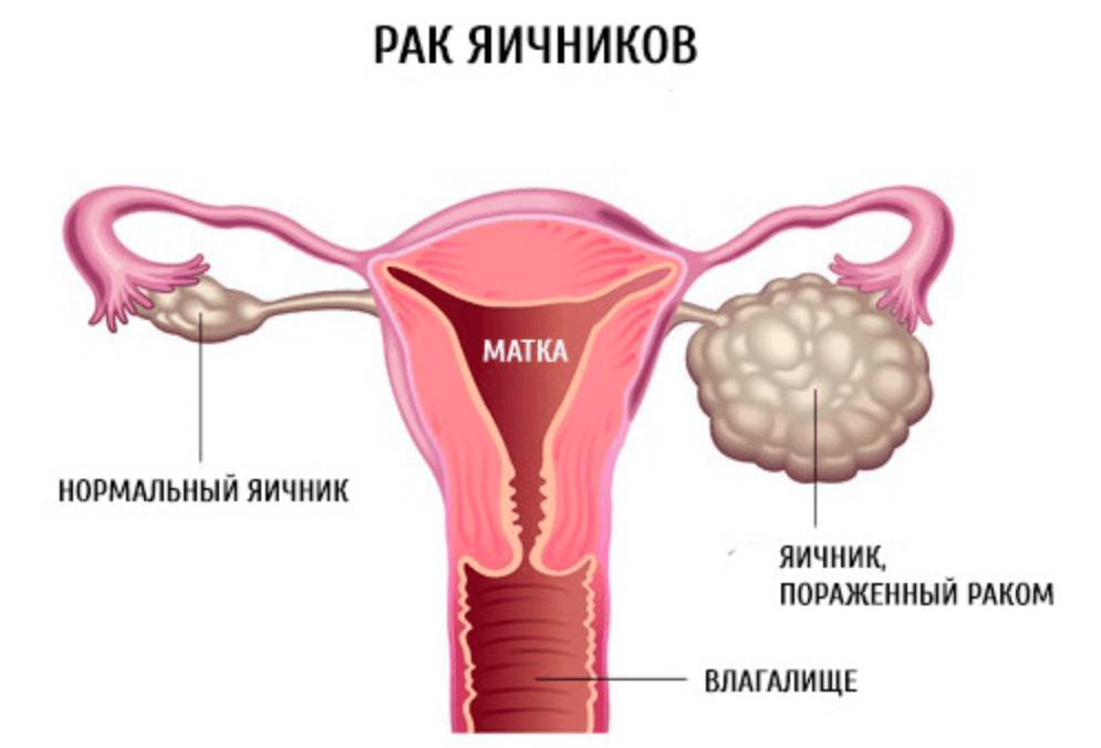 Рак яичника Рак яичника