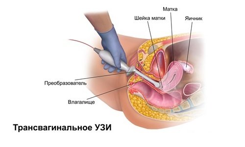 Трансвагинальное УЗИ Трансвагинальное УЗИ