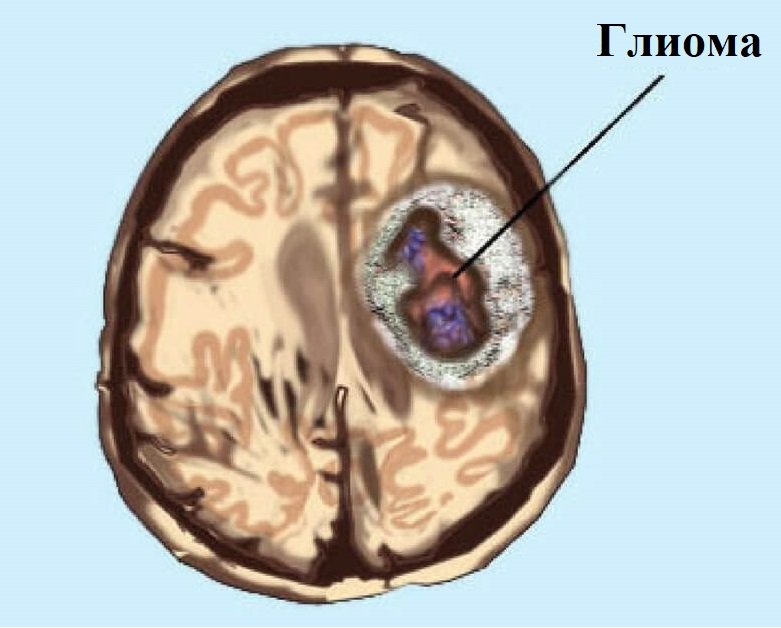 глиома глиома