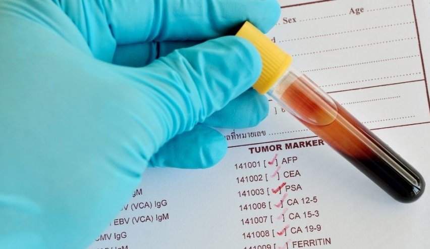 Кровь на онкомаркер CEA Кровь на онкомаркер CEA
