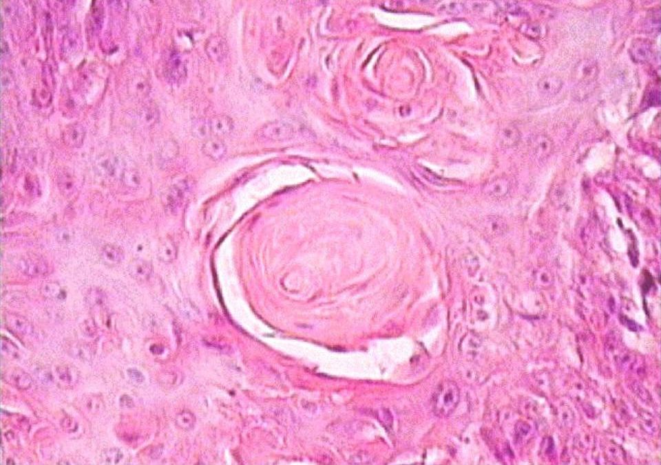 Плоскоклеточный рак