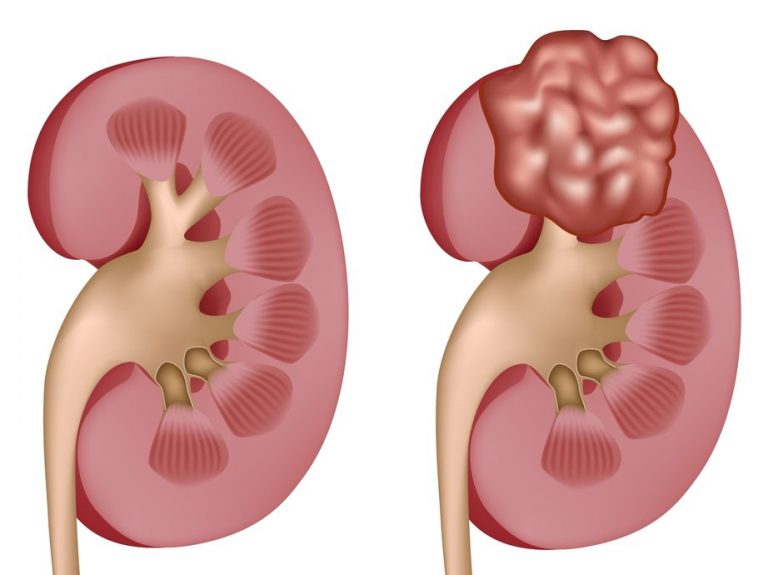 Рак почки Рак почки
