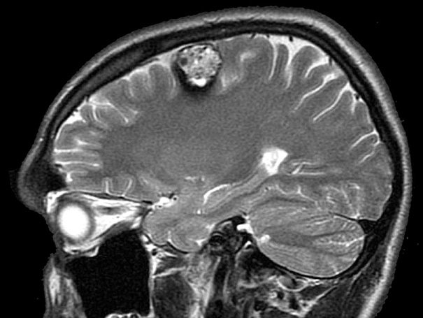 Кавернома головного мозга мрт Кавернома головного мозга мрт