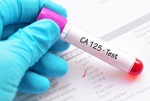 Онкомаркер СА 125 Онкомаркер СА 125