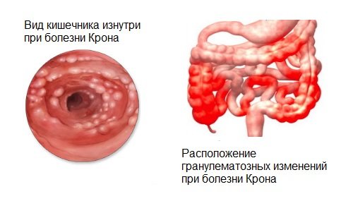 болезнь Крона болезнь Крона