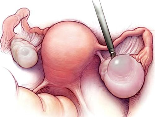 эндометриоидная киста левого яичника эндометриоидная киста левого яичника