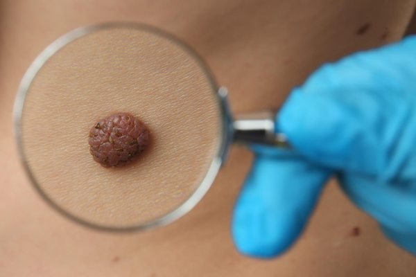 Родинки Родинки