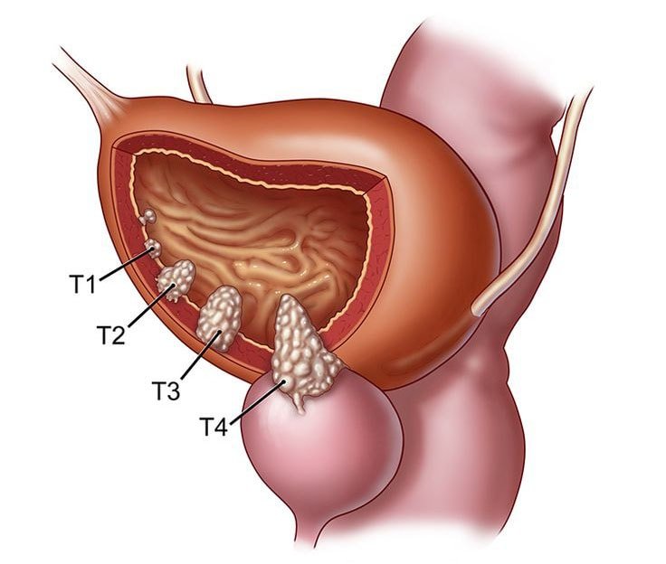 стадии онкологии мочевого пузыря стадии онкологии мочевого пузыря