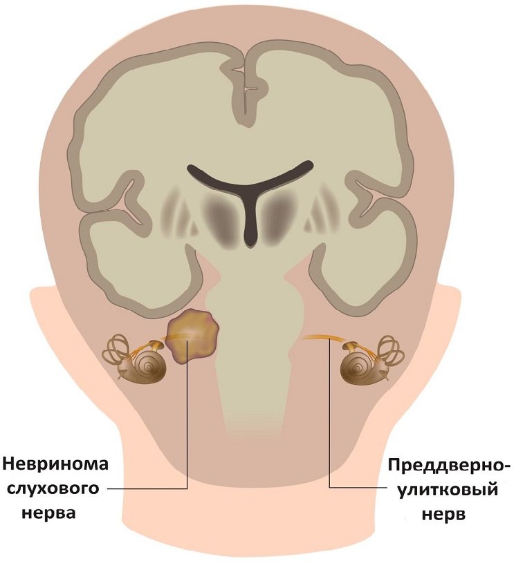 Невринома слухового нерва Невринома слухового нерва