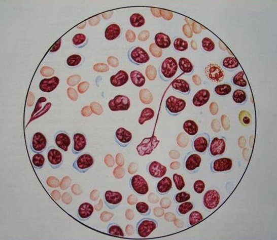 Хронический лимфолейкоз