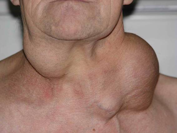 Метастазы в шейных лимфатических узлах Метастазы в шейных лимфатических узлах