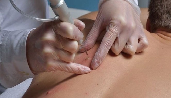 удаление удаление