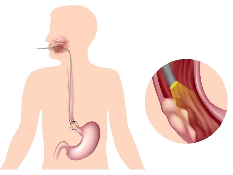 Эндоскопический осмотр пищевода
