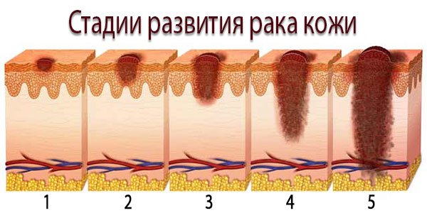 стадии рака кожи стадии рака кожи