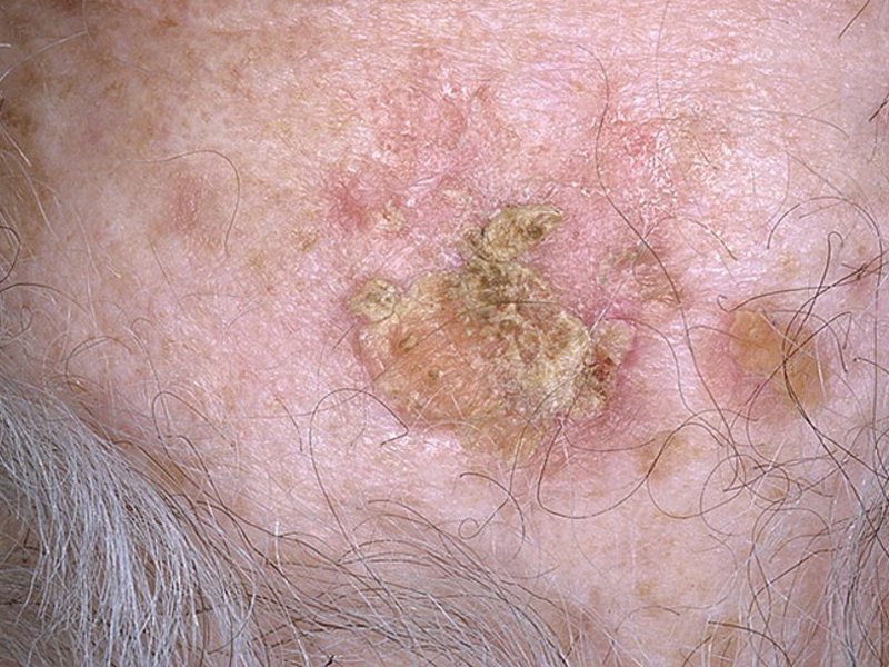 Плоскоклеточный рак кожи Плоскоклеточный рак кожи
