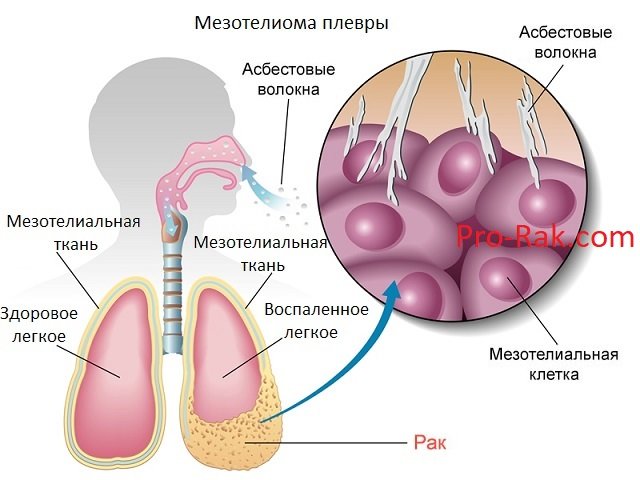 мезотелиома плевры мезотелиома плевры