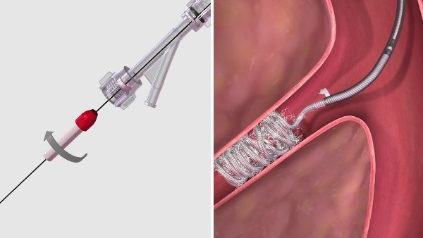 Эндоваскулярная эмболизация Эндоваскулярная эмболизация