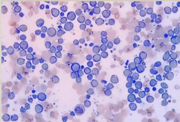 Лимфосаркома микропрепарат Лимфосаркома микропрепарат