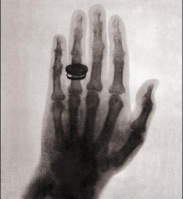 Первый рентгеновский снимок