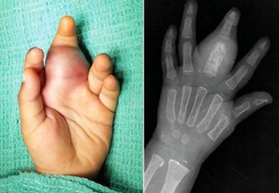 саркома руки