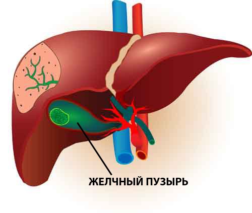 рак желчного пузыря