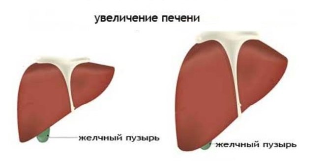 Увеличение печени Увеличение печени