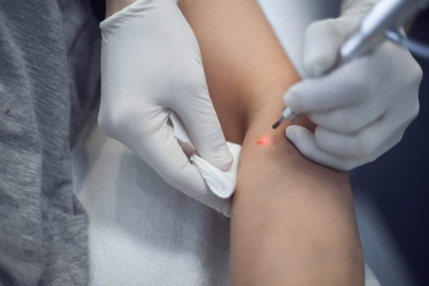 Лазерное удаление ВПЧ Лазерное удаление ВПЧ