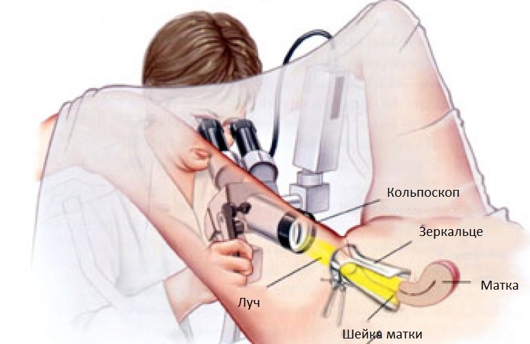 кольпоскопия кольпоскопия