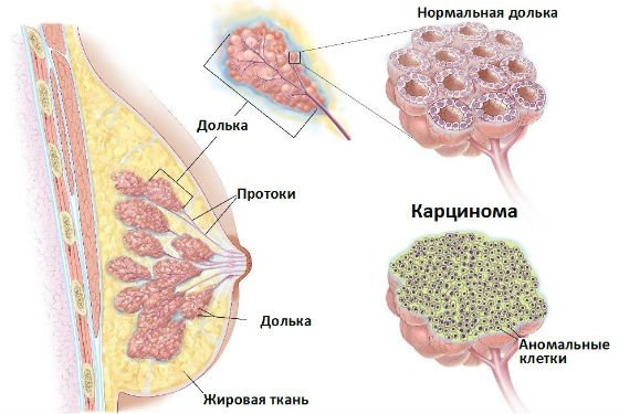 Карцинома молочной железы Карцинома молочной железы